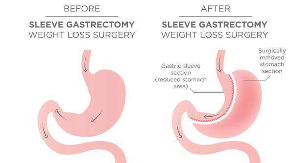 8d822224-gastric-sleeve-facebook7_0ht09a0gi09a00000001o